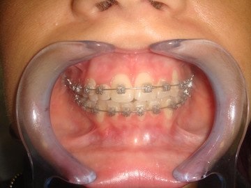 Alinierea dinților, corectarea mușcăturii la adulți și la sistemele detașabile pentru copii (metal,