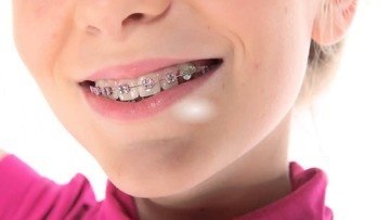 Alinierea dinților, corectarea mușcăturii la adulți și la sistemele detașabile pentru copii (metal,