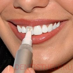 Curățarea chimică a dinților; îndepărtarea plăcilor și a pietrei prin produse chimice; chimic