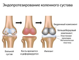 Înlocuirea prețului articulației genunchiului