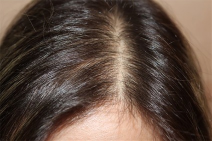 Androgén alopecia kezelés, jelek, okai és tünetei, függetlenül attól, hogy lehetséges-e az androgenetikus gyógyítás