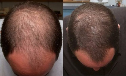 Tratamentul alopeciei anrogene, semne, cauze și simptome, dacă este posibil să se vindece un androgenetic