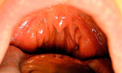 Angina lacunar, follicularis és catarrhal különbségek ezen formák között