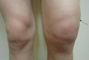 Artrita articulației genunchiului la copii, cauze, simptome, tratament