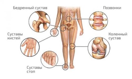 Artrita articulației genunchiului la copii, cauze, simptome, tratament