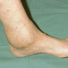 Osteoartrita simptomelor gleznei, tratament, fotografie