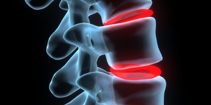 Osteoartrita articulațiilor vertebrale costiere