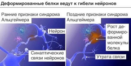 Simptomele inițiale ale bolii Alzheimer și semnele, tratamentul, drogurile, speranța de viață,