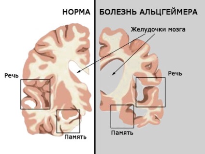 болестта на Алцхаймер началните признаци и симптоми, лечение, лекарства, продължителност на живота,