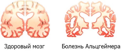 Simptomele inițiale ale bolii Alzheimer și semnele, tratamentul, drogurile, speranța de viață,