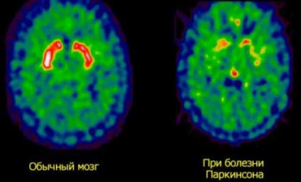 Boala Parkinson - simptome, tratament și consecințe ale bolii
