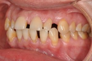 Dinții mari și mici (microdentia și microdentia) cauzează, simptome, tratament