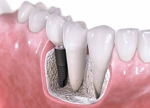 Dinții mari și mici (microdentia și microdentia) cauzează, simptome, tratament