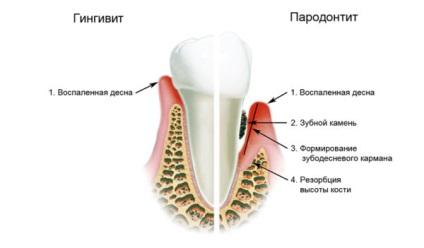 Mai degrabă pentru a trata gingiile inflamate cele mai bune preparate și agenți naționali!