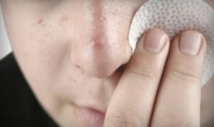 Delex acnee de la acnee și revizuirea acneei, instrucțiuni de utilizare