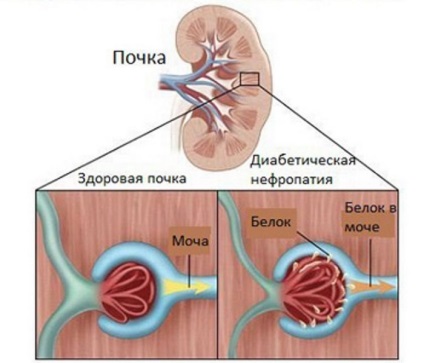 Dieta cu nefropatie renală și o listă cu alimente diabetice