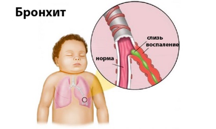 Продължителната кашлица при дете без температура, която трябва да се направи