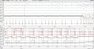 Eliminarea eficientă a blocadelor atrioventriculare la un pacient cu un grad sever de sindrom