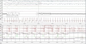Az atrioventricularis blokádok hatékony eltávolítása súlyos szindrómás betegben (blokád) Az atrioventricularis blokádok hatékony eltávolítása súlyos szindrómás betegeknél