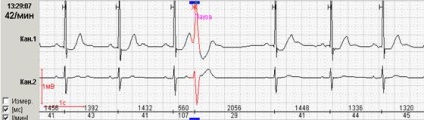 Ekg, partea 3b