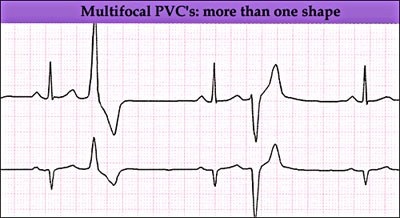 Ekg, partea 3b