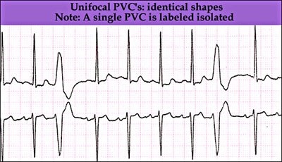 Ekg, partea 3b