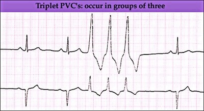 Ekg, partea 3b