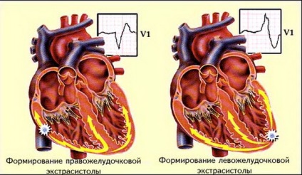 Extrasistolele din inimă sunt periculoase, diagnostice și modalități de tratament
