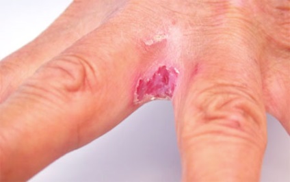 Eczemul pe mâini, tratamentul fisurilor și al blisterelor