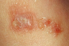 Eczemele pe abdomen prezintă tratament și îngrijirea pielii