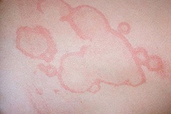 Eczemele pe abdomen prezintă tratament și îngrijirea pielii