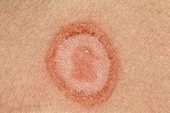 Eczemă în zona inferioară la bărbați și femei