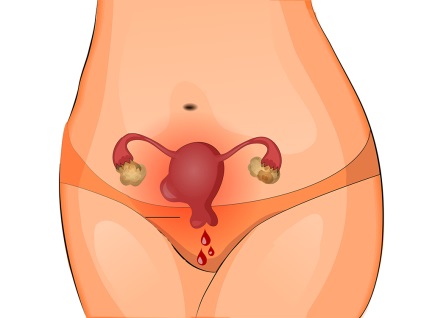 Eroziunea simptomelor de col uterin, cauze, tratament