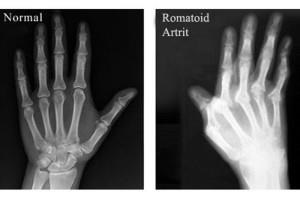 Există vreun beneficiu în fizioterapia bolilor articulare?