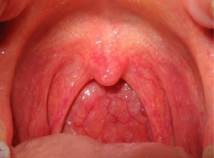 Pharyngitis simptome alergice și de tratament la adulți și copii