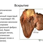 Foraminotomie, ceea ce este - foraminutomie în Statele Unite, prevenirea și tratamentul diferitelor boli