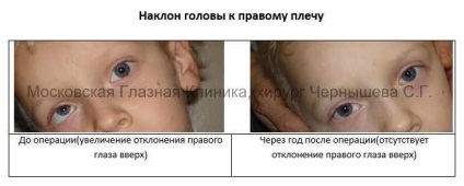 Fotografii ale pacienților înainte și după operația de corecție discontinuă