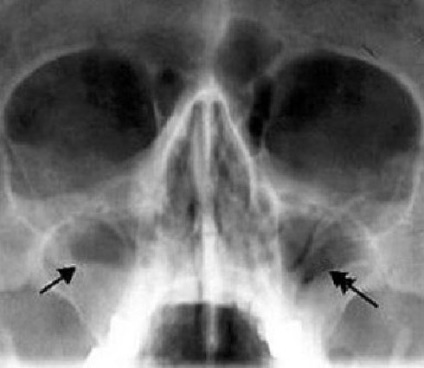 Sinusitis, Invh - Sürgősségi és Újjáépítési Sebészeti Intézet