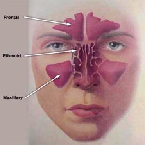 Sinusitis, Invh - Sürgősségi és Újjáépítési Sebészeti Intézet