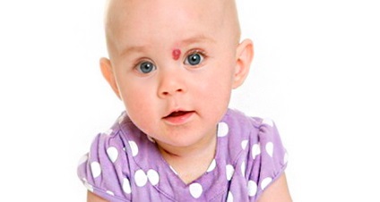 Az újszülöttek hemangioma - kezelés létezik! Gyermekek a városban