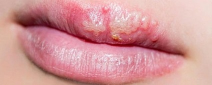 Herpesul pe buze în timpul sarcinii, tratament