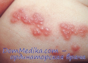 Eczeme herpetice - diagnostic, tratament