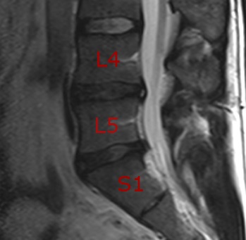 Disc herniat - cauze de educație, simptome, diagnostic, tratament, prognostic