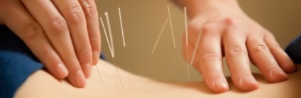 Acupunctura pentru caracteristicile osteochondrozei (fotografie, video)