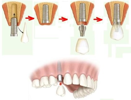 Implantarea dinților în Volgograd, prețuri și metode