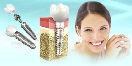 Implantarea dinților în Volgograd, prețuri și metode
