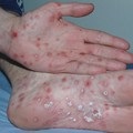 Boli infecțioase 1