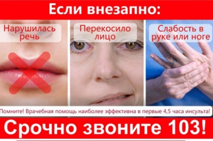Accident vascular cerebral - nu o sentință, sănătate, aif, Krasnoyarsk