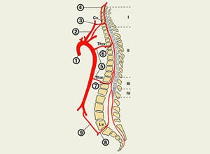 Accident vascular cerebral provoacă simptome și consecințe ale măduvei spinării