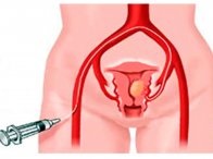 Cum să se ocupe de îndoirea uterului, diagnosticul medical tradițional și tratamentul bolilor